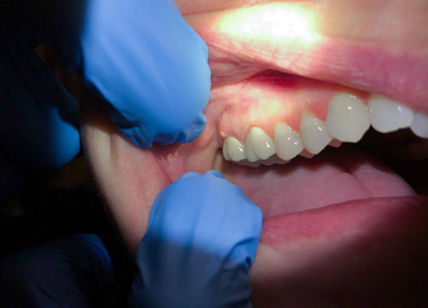 Best Knocked-Out Tooth Emergency  in Maryvle, IL