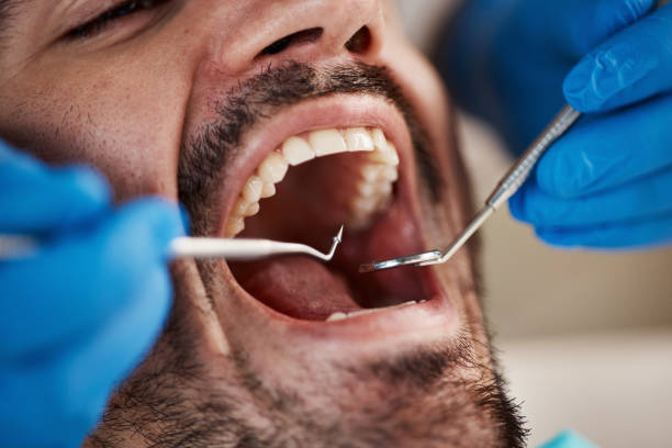 Best Chipped Tooth Repair Near Me  in Maryvle, IL